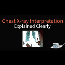 Chest X-Ray Interpretation Explained Clearly
