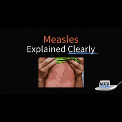 Measles (rubeola) Explained Clearly