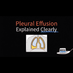 Pleural Effusion Explained Clearly - Medcram