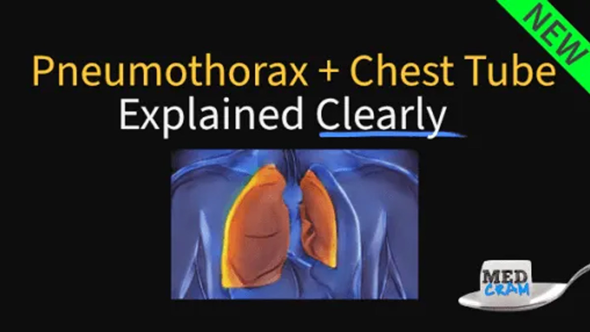 Understanding Pneumothorax and Chest Tubes A Comprehensive Guide
