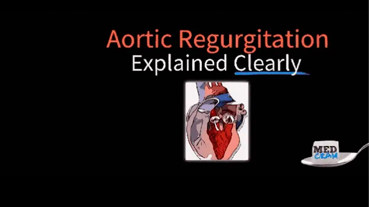 Understanding Aortic Regurgitation: Causes, Symptoms, and Treatment