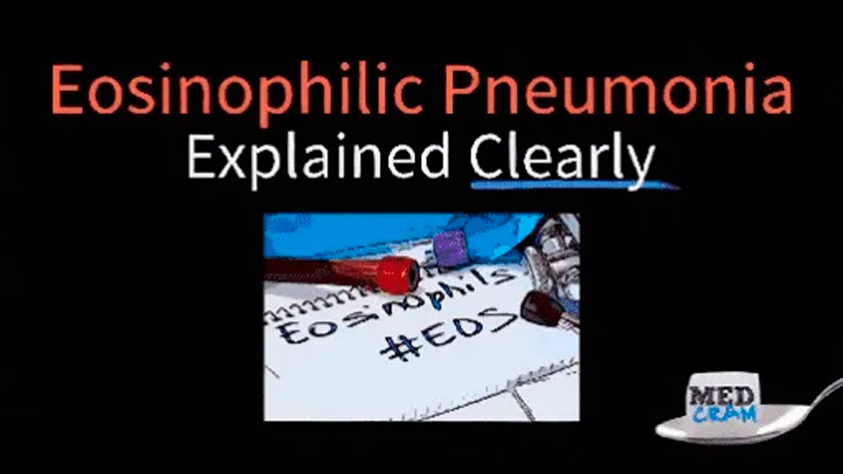 Eosinophilic Pneumonia Explained Clearly: Understanding the Condition