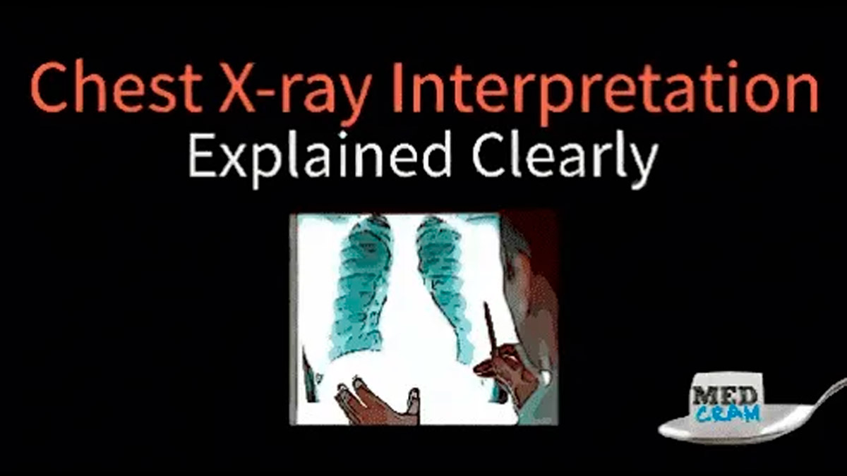 Mastering Chest X-Ray Interpretation A Comprehensive Guide