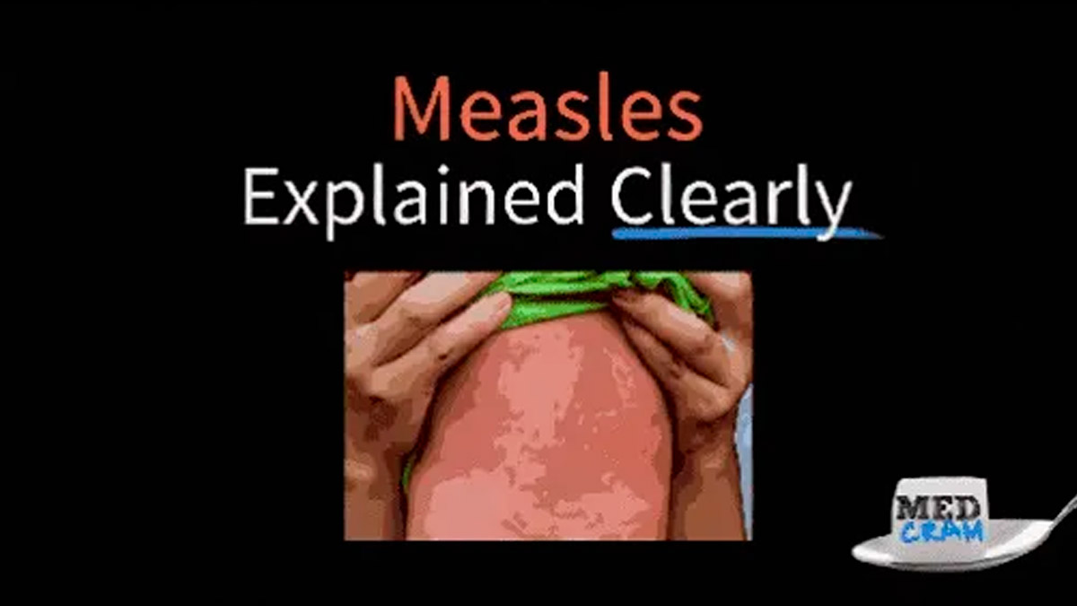 Measles (rubeola) Explained Clearly – Medcram