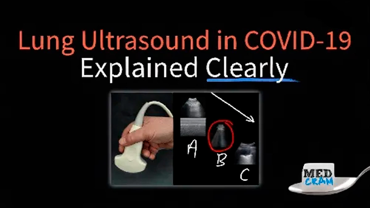 Lung Ultrasound in COVID-19: A Vital Tool for Diagnosis and Monitoring